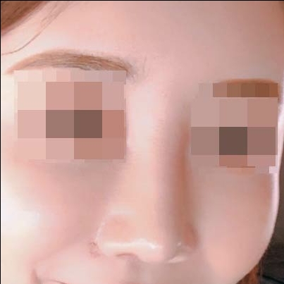 콧볼보톡스 후기
