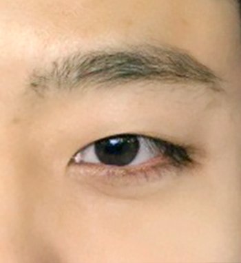 쌍꺼풀(절개) 후기