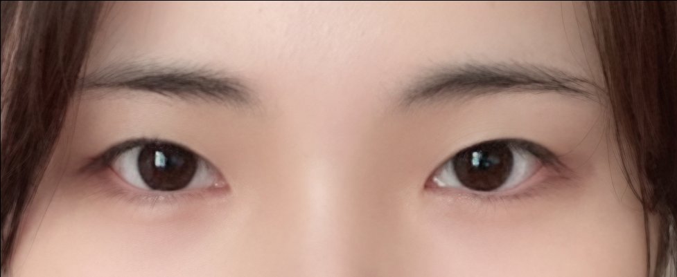 쌍꺼풀(절개) 후기