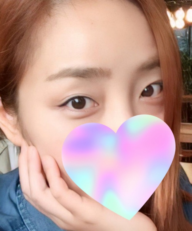 쌍꺼풀(절개) 후기