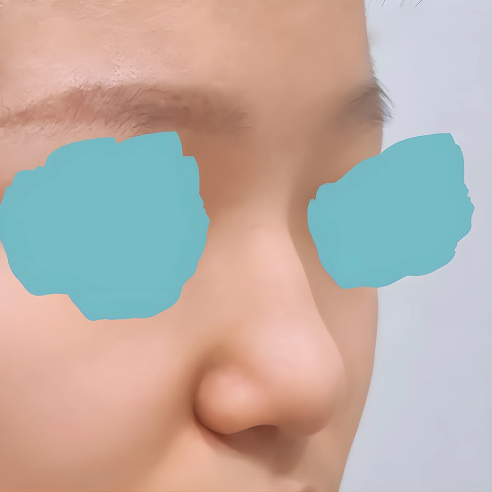 코끝(기증연골) 후기