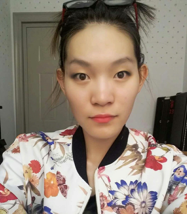 쌍꺼풀(매몰) 후기