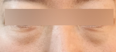 눈밑지방재배치 후기