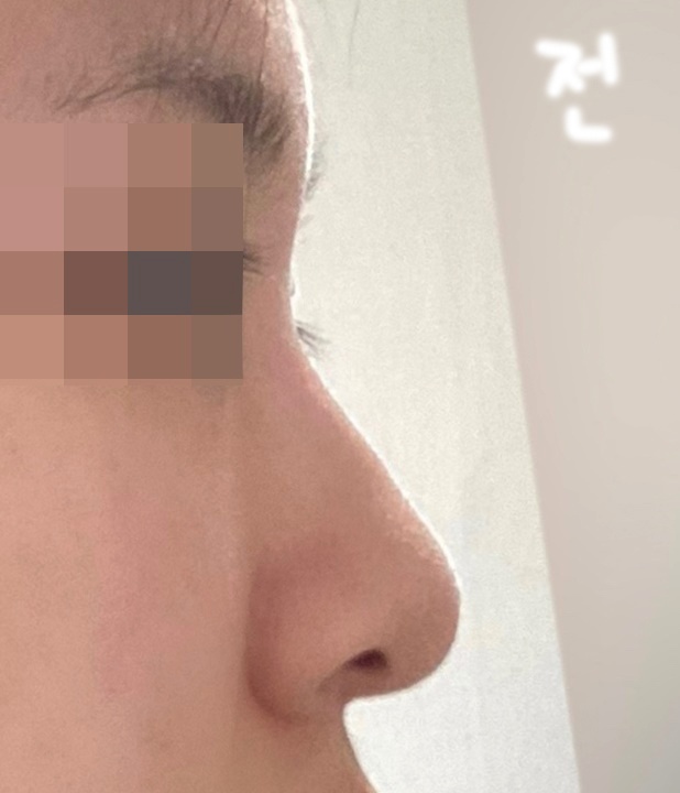 콧볼축소 후기