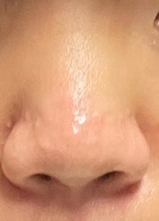 코끝(기증연골) 후기