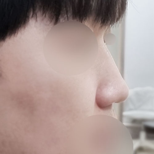 콧대(보형물) 후기