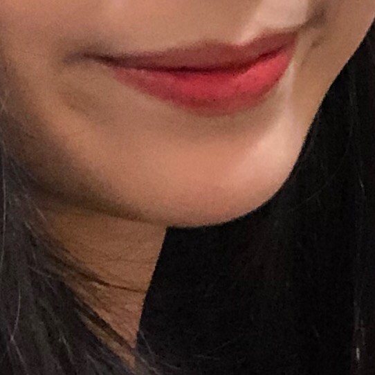 입꼬리성형 후기