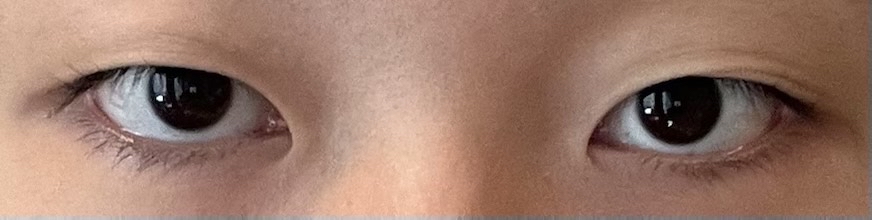 쌍꺼풀(자연유착) 후기