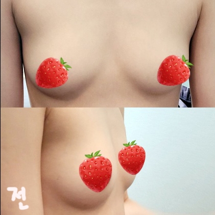 가슴(보형물) 후기