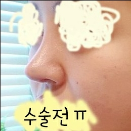 코재수술 후기