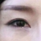 눈재수술 후기