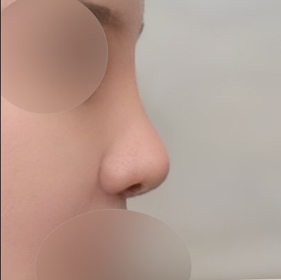 코재수술 후기