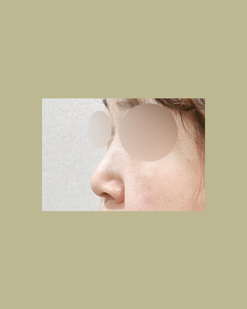 콧대(보형물) 후기