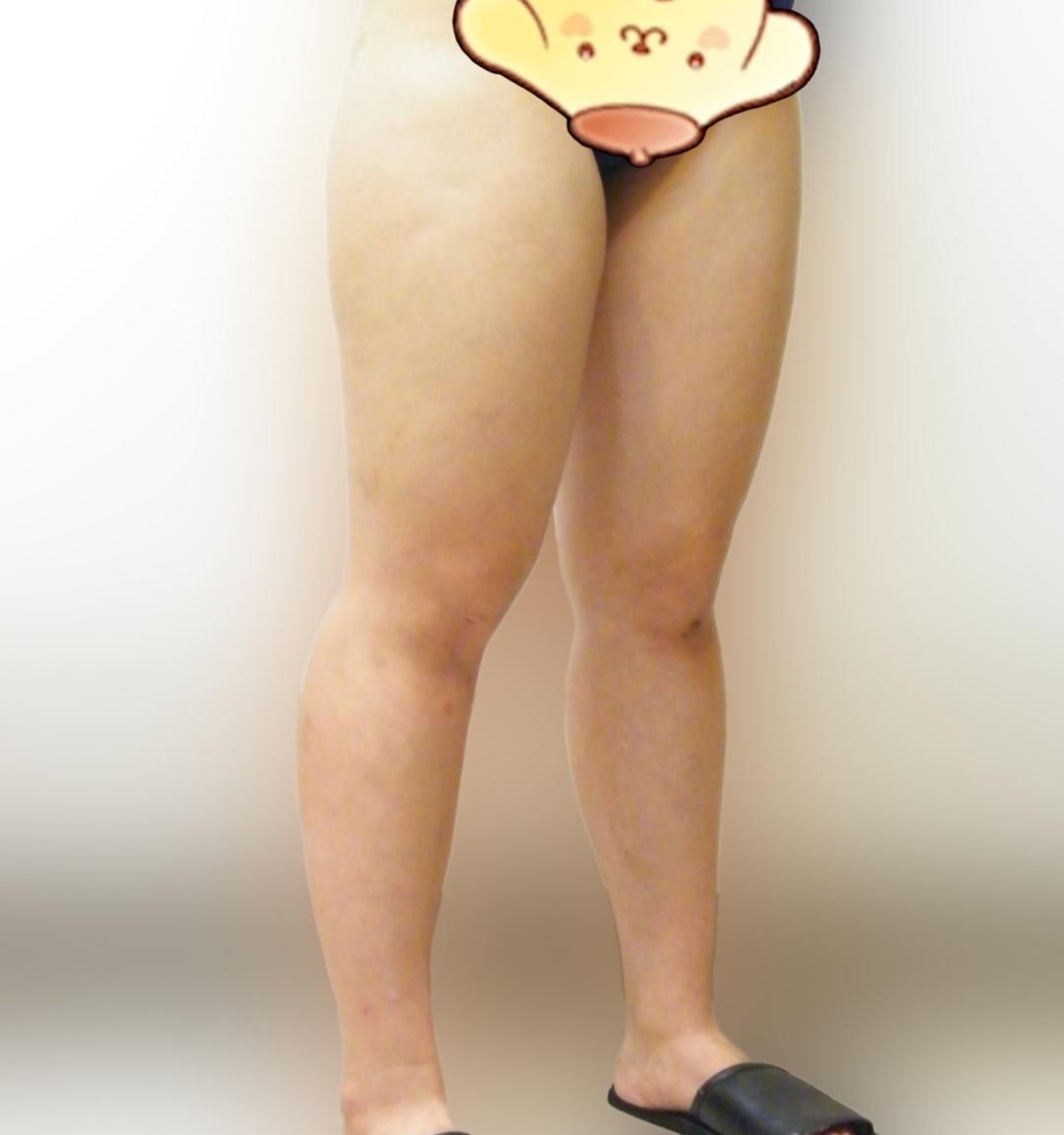 허벅지지방흡입 후기