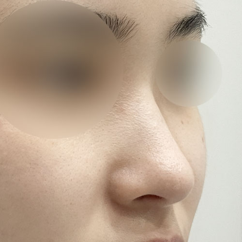 코끝(기증연골) 후기
