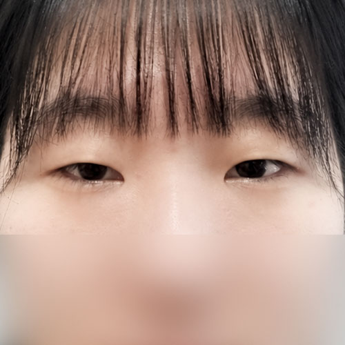 쌍꺼풀(자연유착) 후기