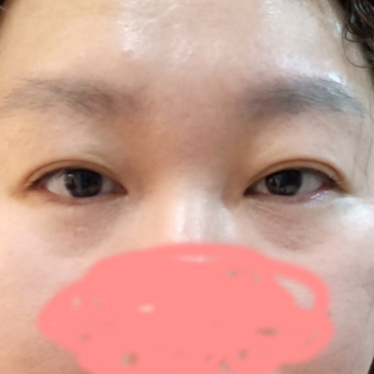 쌍꺼풀(절개) 후기
