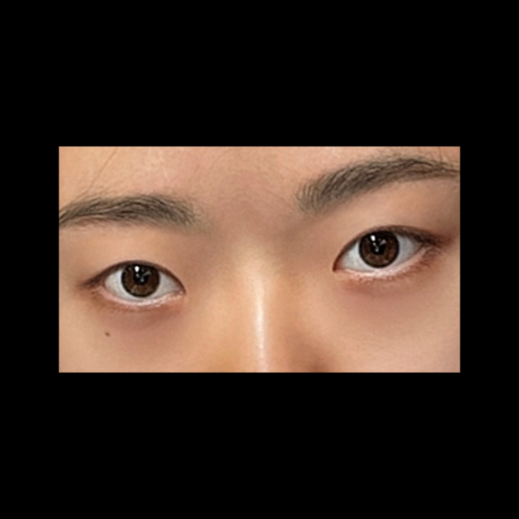 쌍꺼풀(절개) 후기