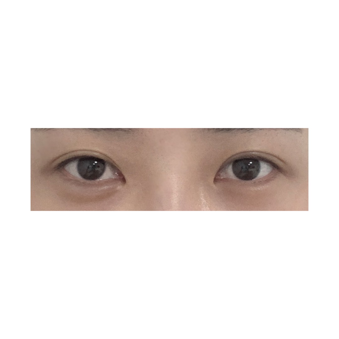 쌍꺼풀(절개) 후기