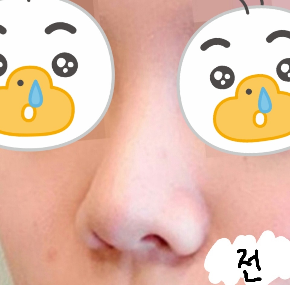 코재수술 후기
