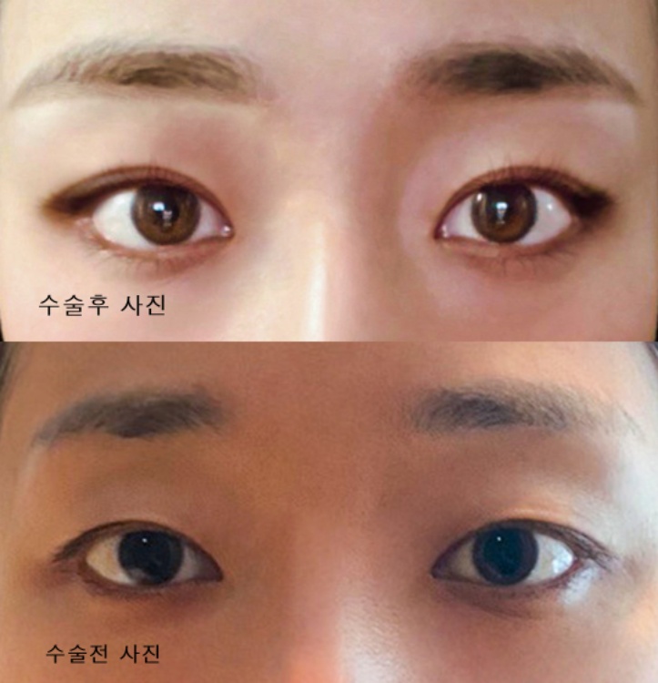 쌍꺼풀(매몰) 후기