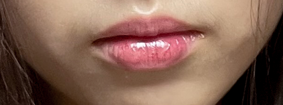 입꼬리성형 후기