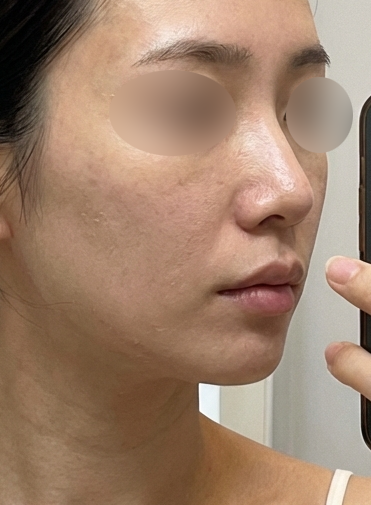 온다리프팅 후기
