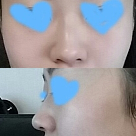 콧볼축소 후기