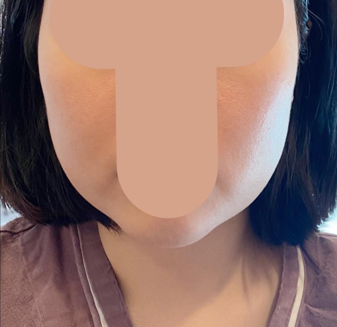 실리프팅 후기