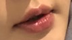 입꼬리성형 후기