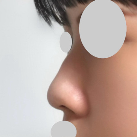 코절골술 후기