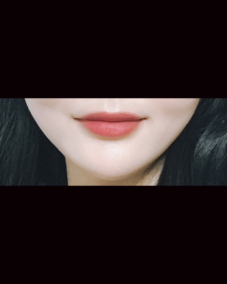 입꼬리성형 후기