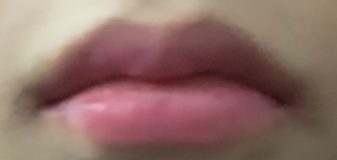 입꼬리성형 후기