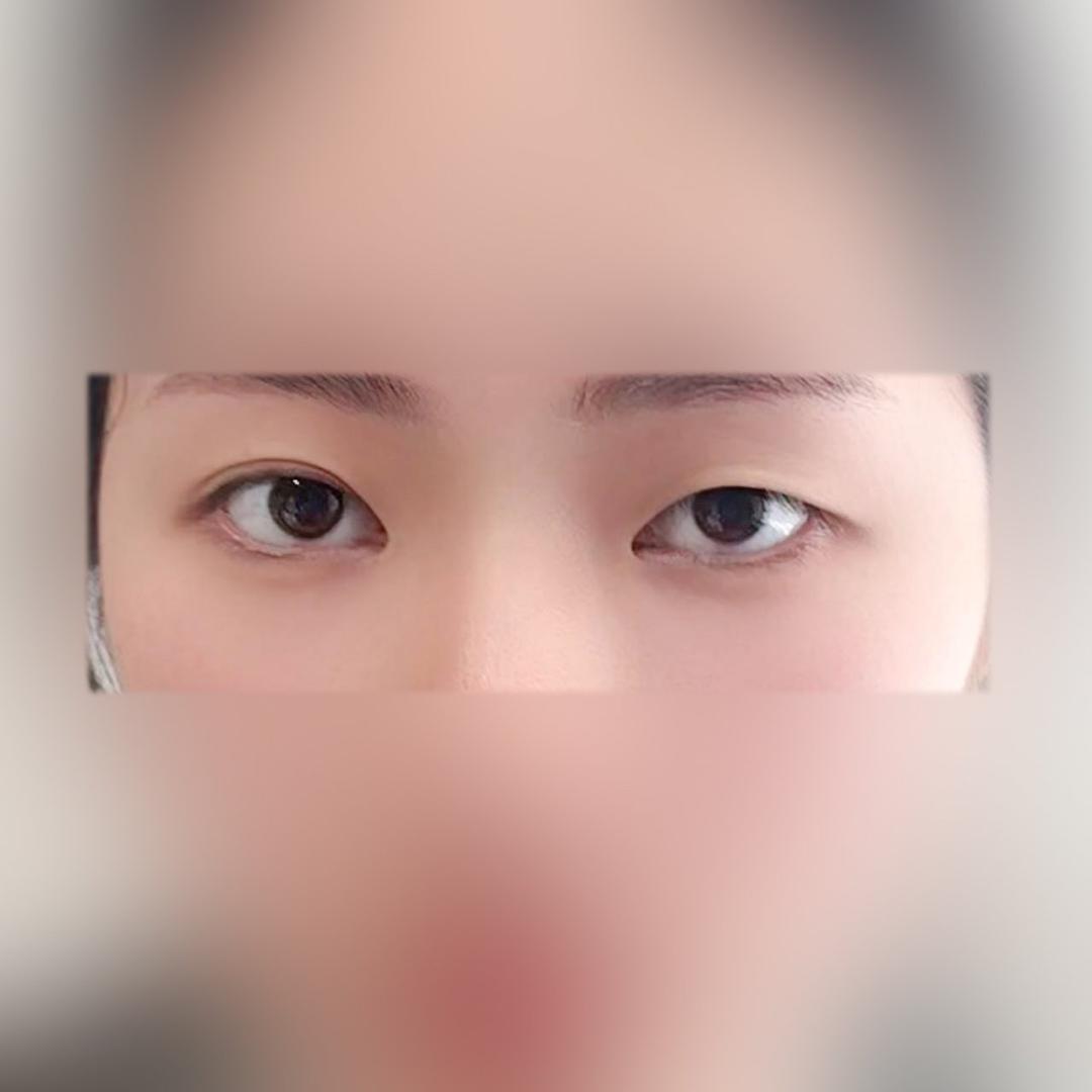 쌍꺼풀(절개) 후기