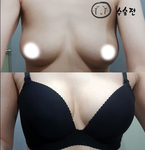 가슴거상술+확대 후기