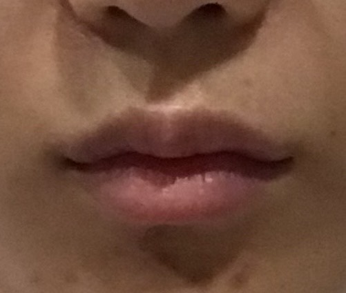 입꼬리성형 후기