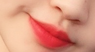 입꼬리성형 후기