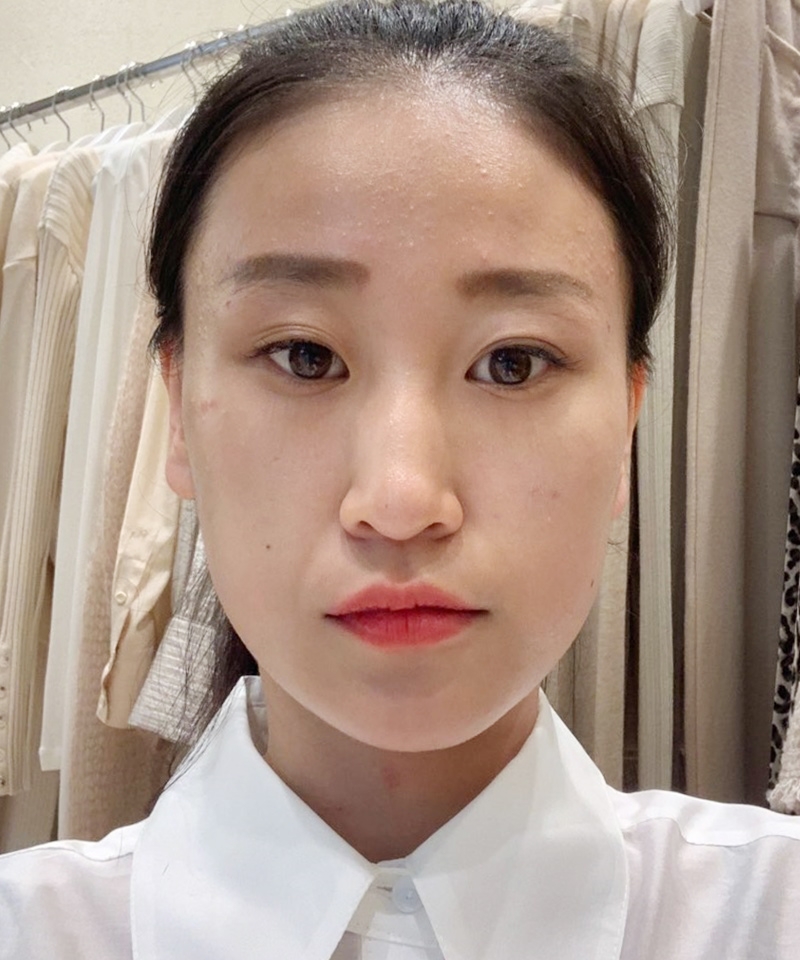 풀페이스지방이식 후기