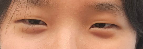 쌍꺼풀(절개) 후기