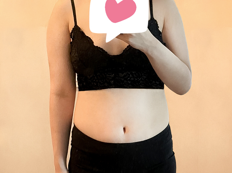 팔지방흡입 후기