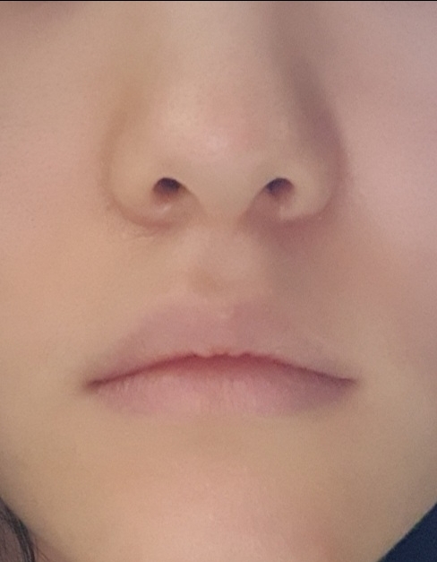 입꼬리성형 후기