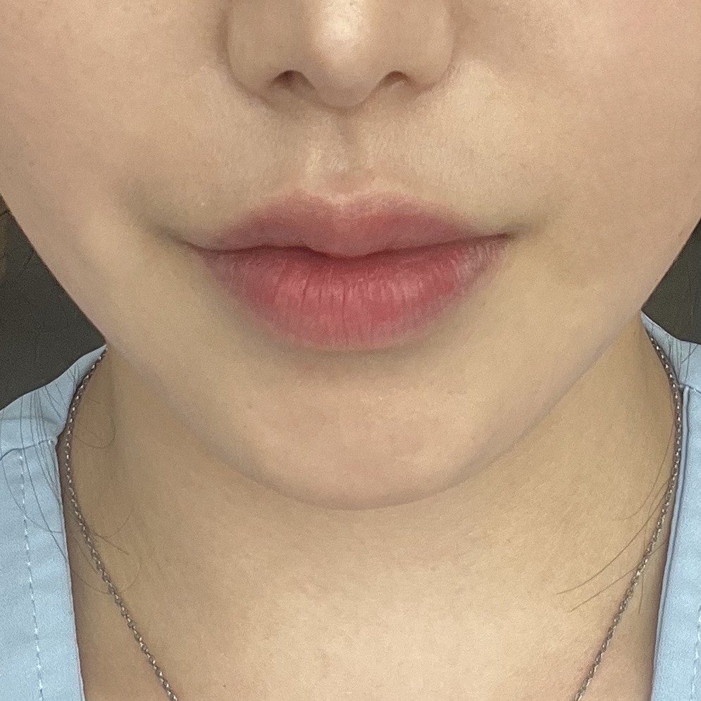 입꼬리성형 후기