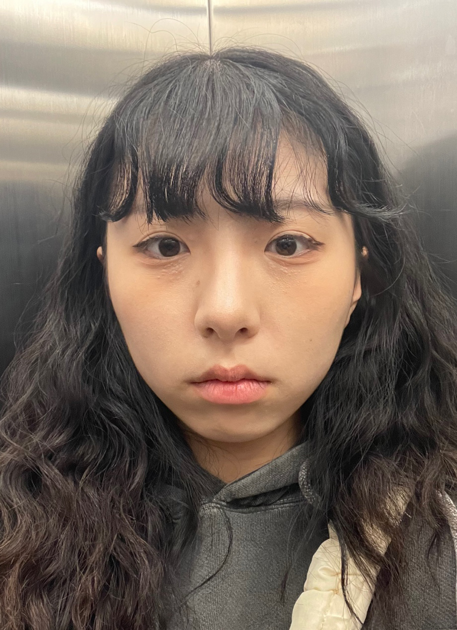 눈재수술 후기