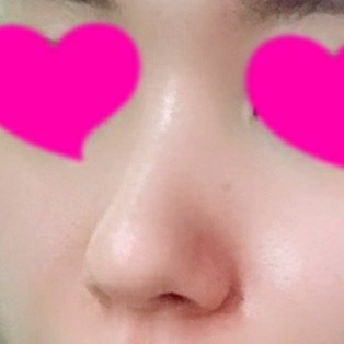 콧대(보형물) 후기