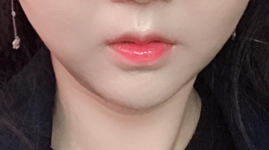 입꼬리성형 후기
