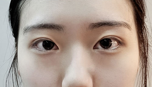 눈재수술 후기