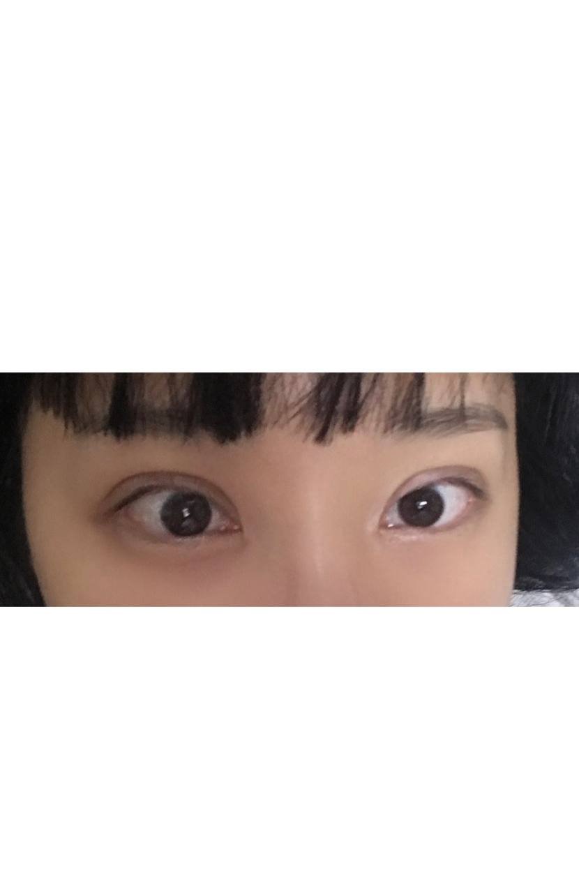 눈재수술 후기