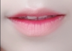 입꼬리성형 후기