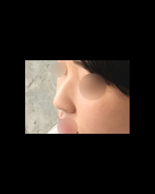 코끝(자가연골) 후기