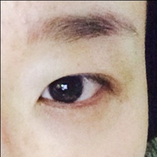 쌍꺼풀(절개) 후기